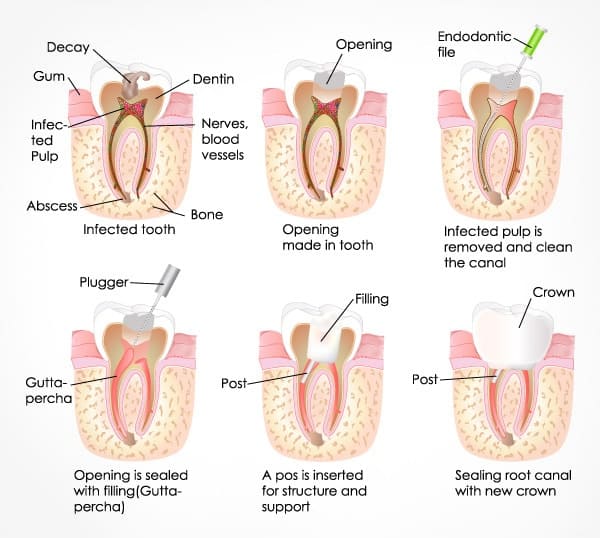 best root canal treatment in singapore
