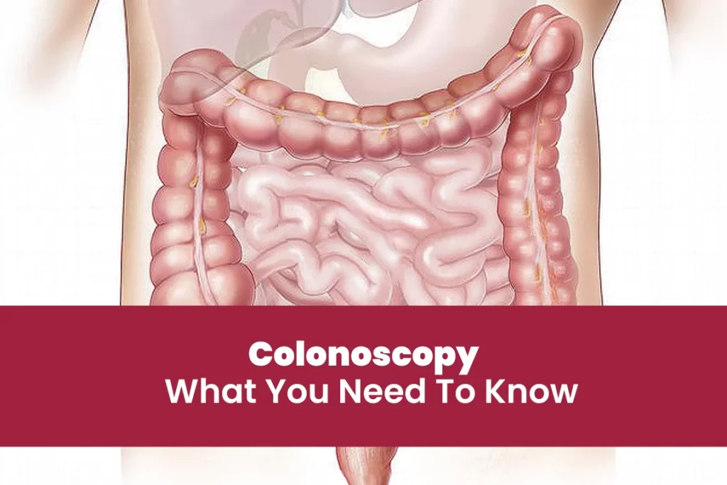 Colonoscopy - What You Need to Know
